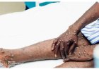 RDC : l’épidémie de Mpox officiellement maîtrisée après deux ans de riposte, annonce le gouvernement