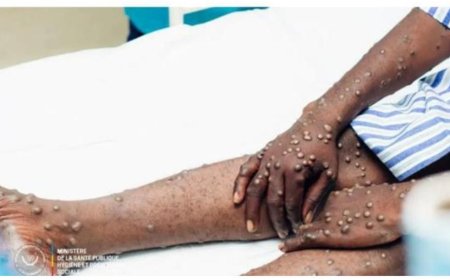 RDC : l’épidémie de Mpox officiellement maîtrisée après deux ans de riposte, annonce le gouvernement